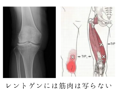 レントゲンと筋肉