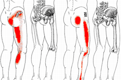 小殿筋トリガーポイント